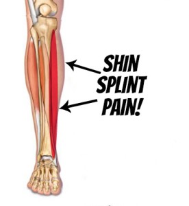 Shin Splint Pain